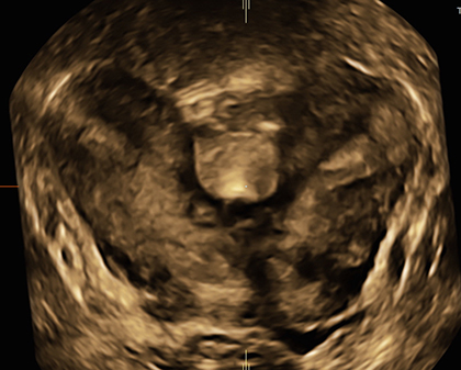uterus bicorne grossesse saignement