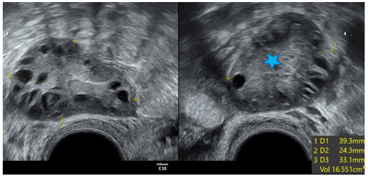 Comment se diagnostique le Syndrome des Ovaires Polykystiques?