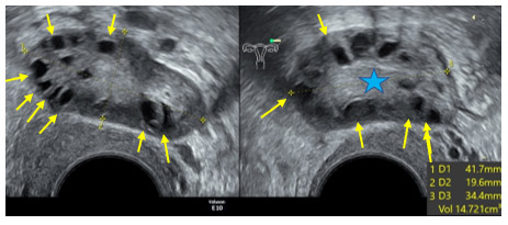 ASPECTS ECHOGRAPHIQUES DES OVAIRES POLYKYSTIQUES