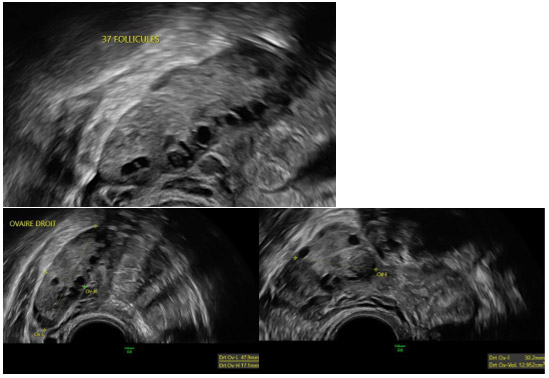 ASPECTS ECHOGRAPHIQUES DES OVAIRES POLYKYSTIQUES