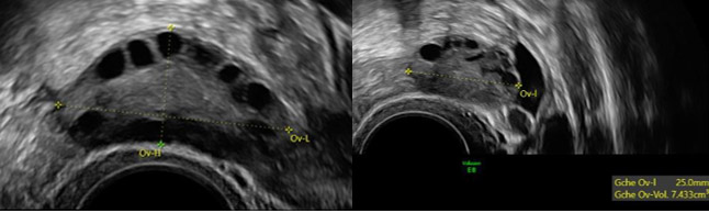 ASPECTS ECHOGRAPHIQUES DES OVAIRES POLYKYSTIQUES