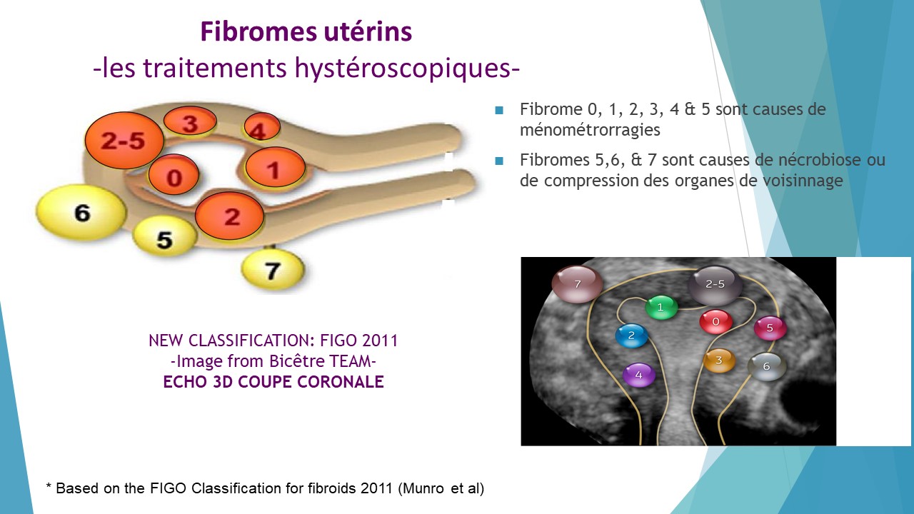 Les fibromes utérins
