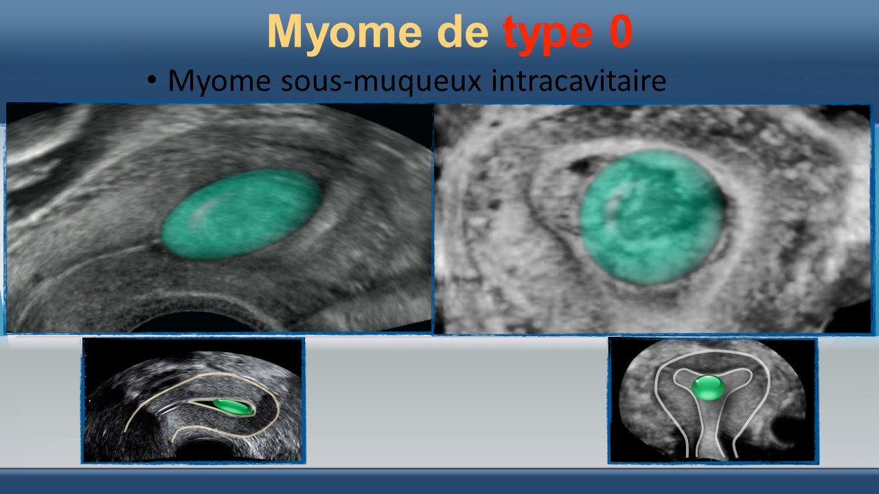 Les fibromes utérins