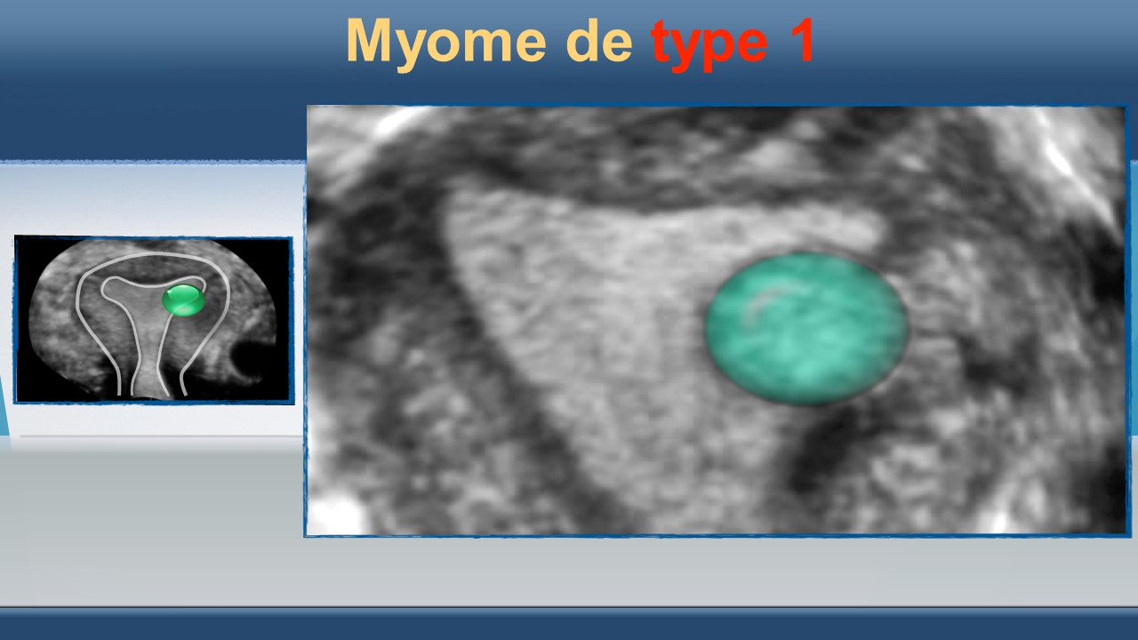 Les fibromes utérins