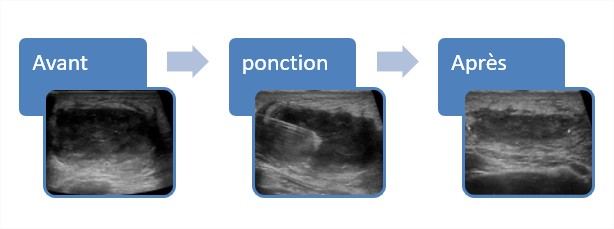 Prise en charge par ponctions écho-guidées des abcès du sein ...