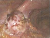 Endométriose ovarienne et infertilité : chirurgie ou fécondation ...