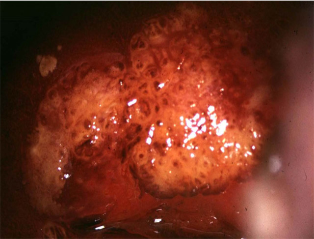 Même col, au Lugol l’aspect devient celui d’un condylome