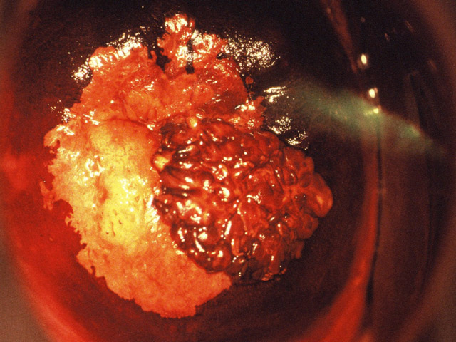 remarquable aspect de condylome acuminé iode inhomogène et d’une zone jaune paille de TAG II