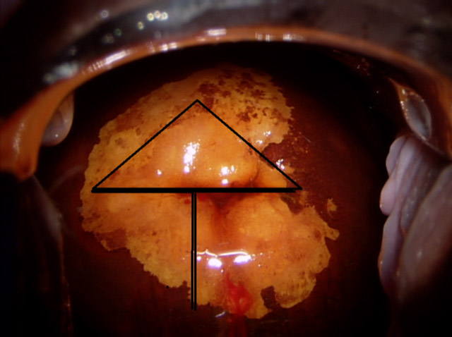 Remarquez le vaisseau pathologique dans cette zone de haut grade - photo 8 : l’anse n’effectue la coupe que de la zone de TAG II limitée par la inner border line                   Elle laisse en place la TAG I inhomogène (qui sera détruite au Laser)