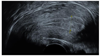 Cliché 1 : endomètre mesuré à 13 mm en trois feuillets d’aspect péri-ovulatoire