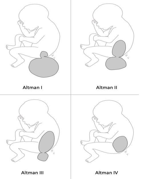 Figure 1 : Classification de Altman des tératomes sacro-coccygiens.