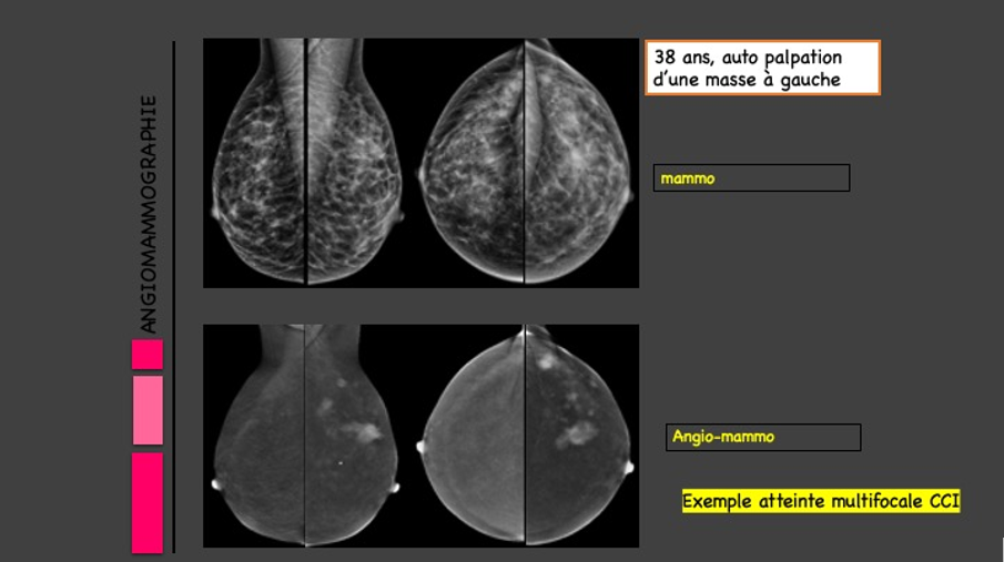 L’angio-mammographie