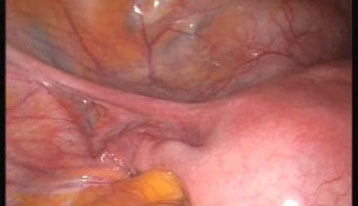 Hystérectomie supra-cervicale par cœlioscopie | Gynéco Online